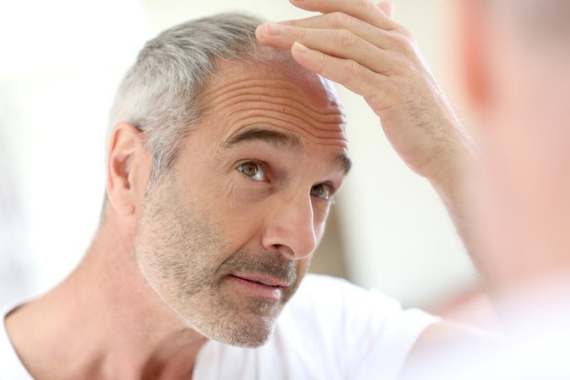 Male Pattern Baldness