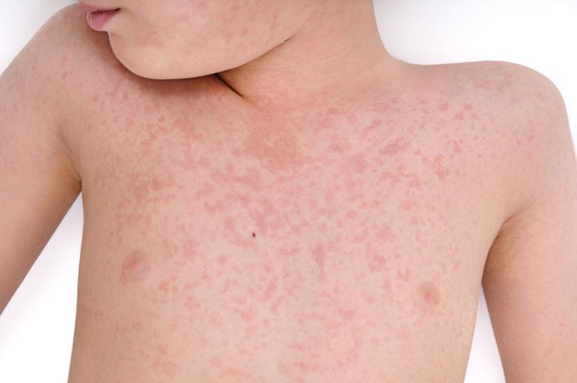 Hives in Children: Causes and Treatment
