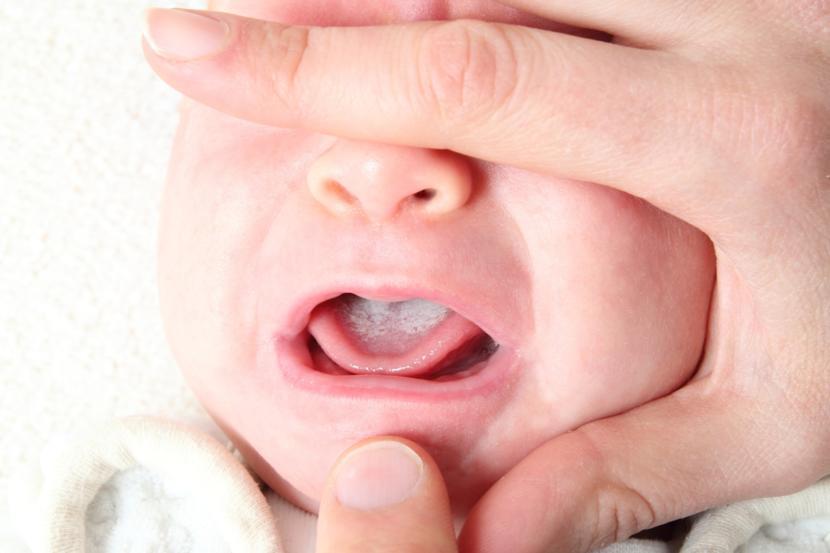 What is Apert Syndrome?
