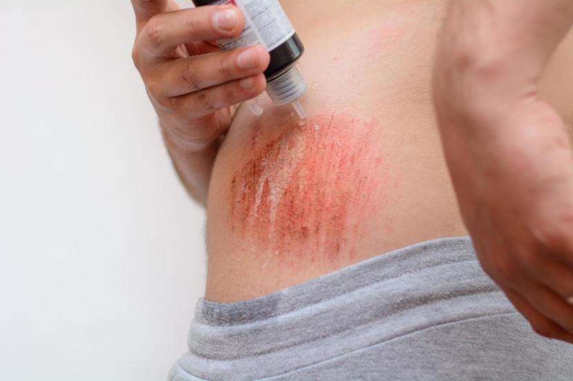 All About Skin Abrasions