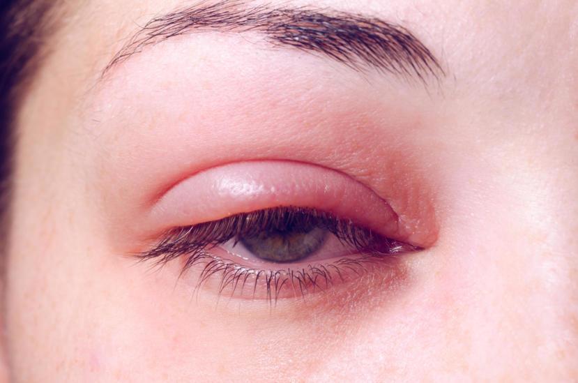 What Could A Swollen Eyelid Mean 10