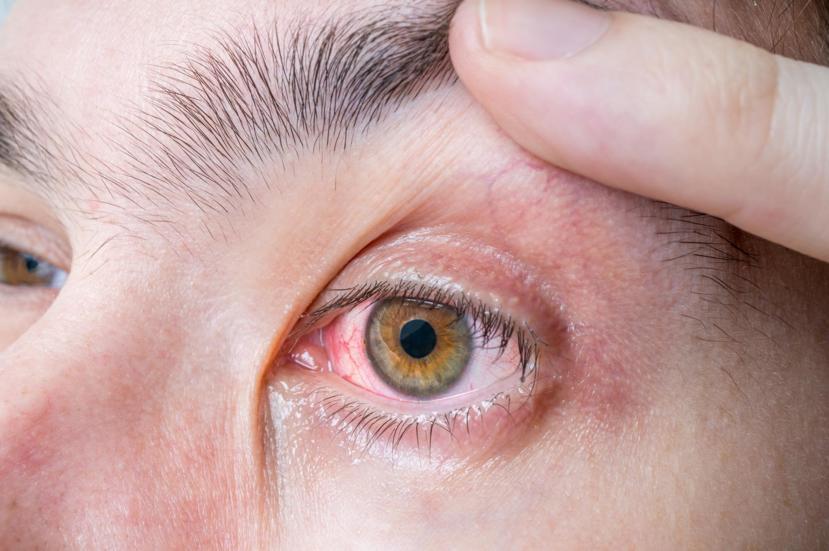 What Causes Iritis?