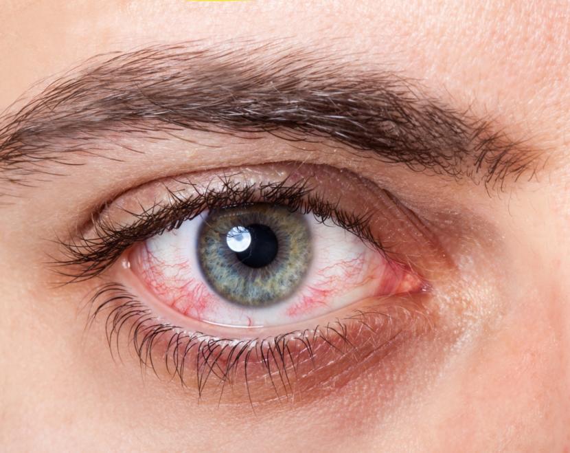 What Tests Determine Conjunctivitis?