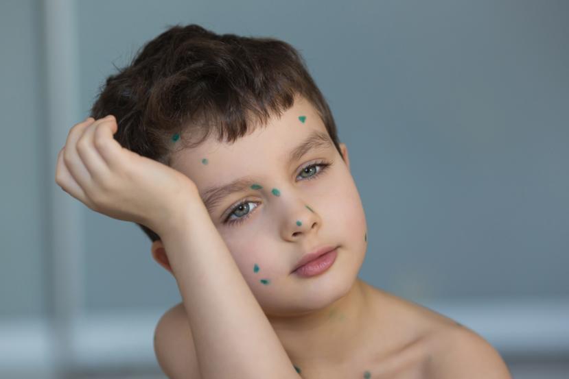 Does My Child Have Chicken Pox?