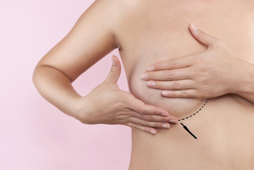 Fat Injections Can Hinder Mammograms