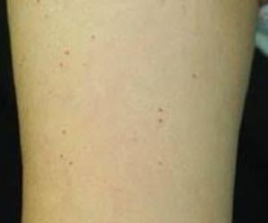 pinpoint red dots on skin treatment