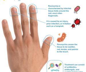 Paronychia (Nail Infection): Types and 5 Ways to Treat Paronychia
