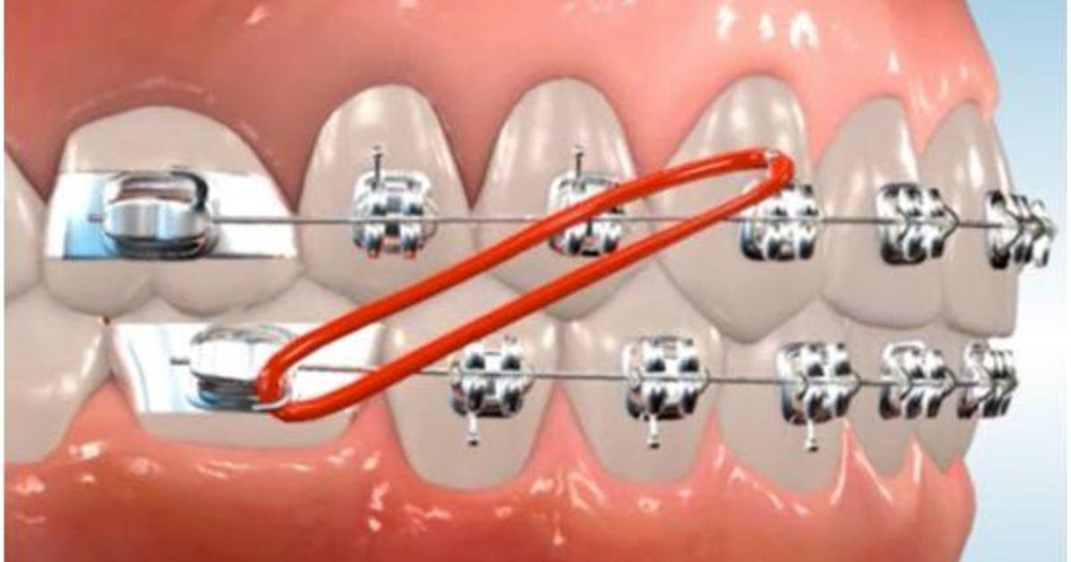 What Are Orthodontic Elastics and How Do They Work?