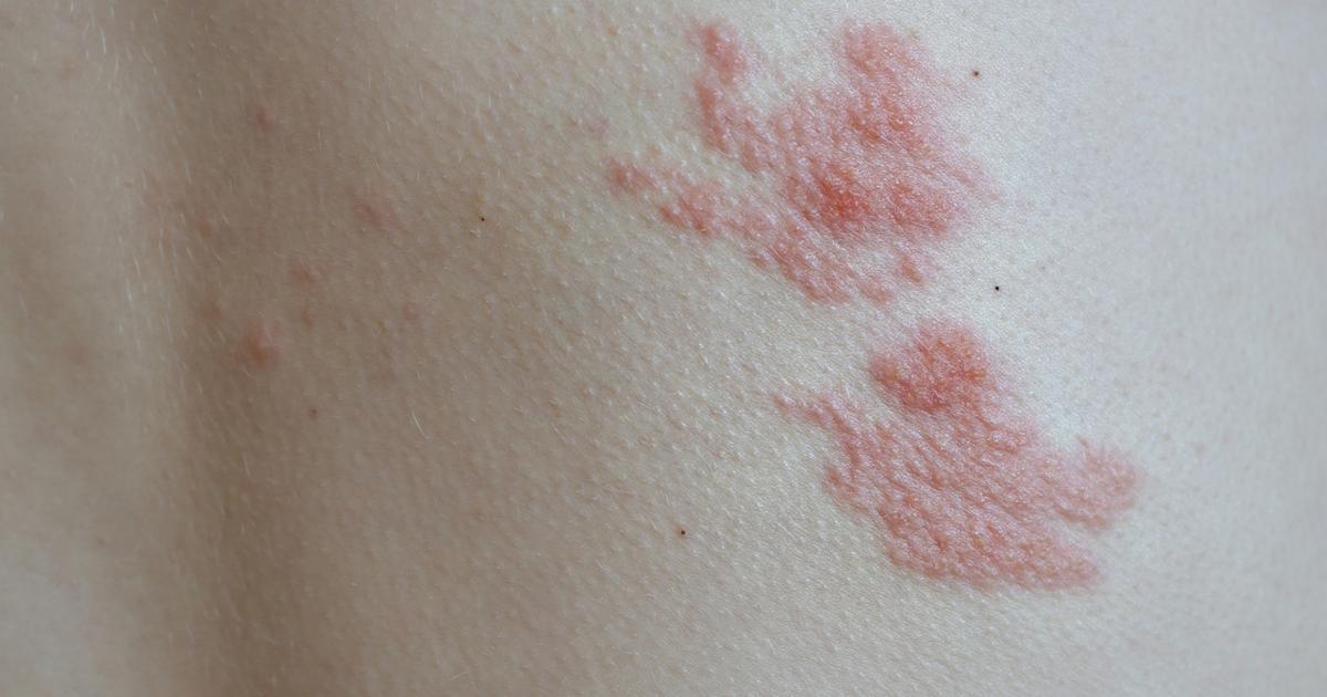 what is shingles and is it contagious