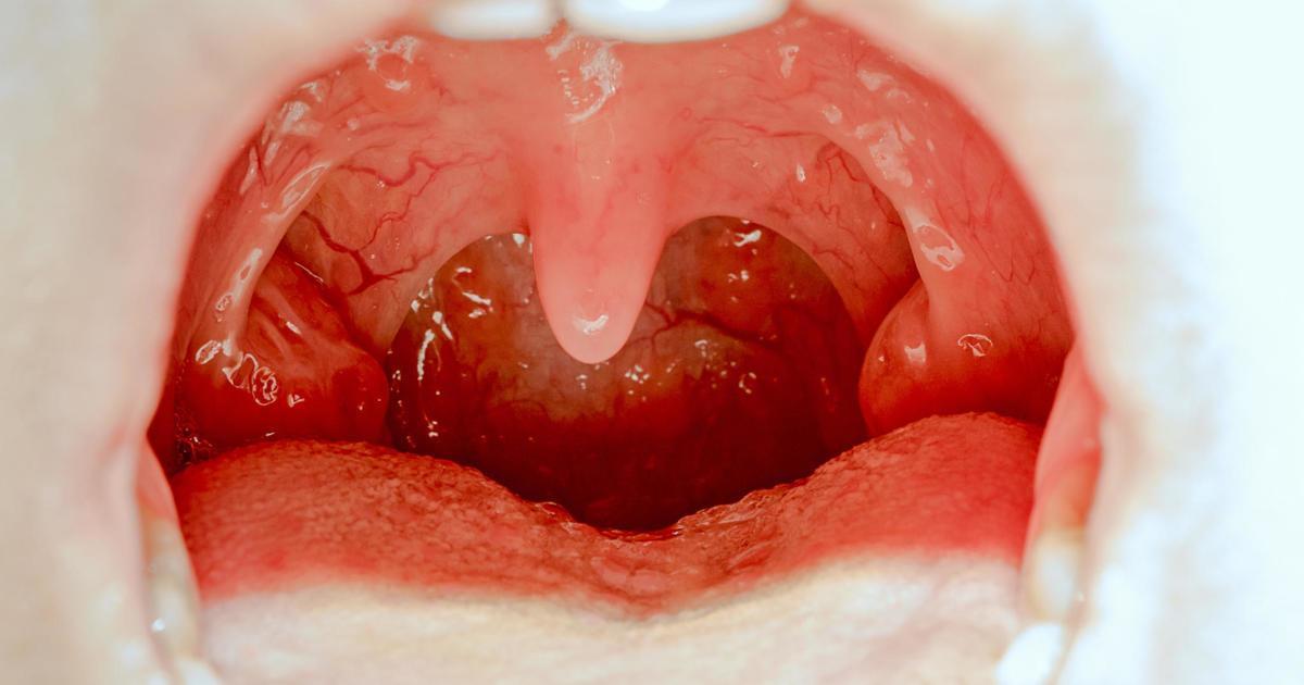 Tonsils Pictures: Conditions, Diagnosis, and Treatments