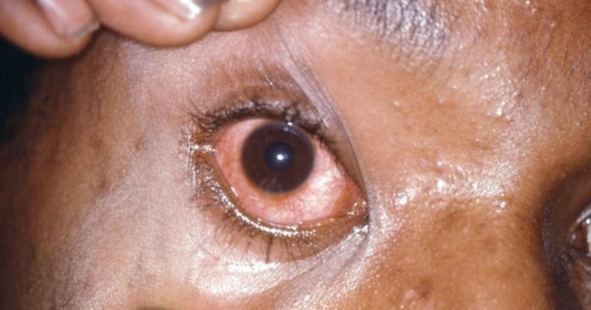 gonorrhea symptoms eyes