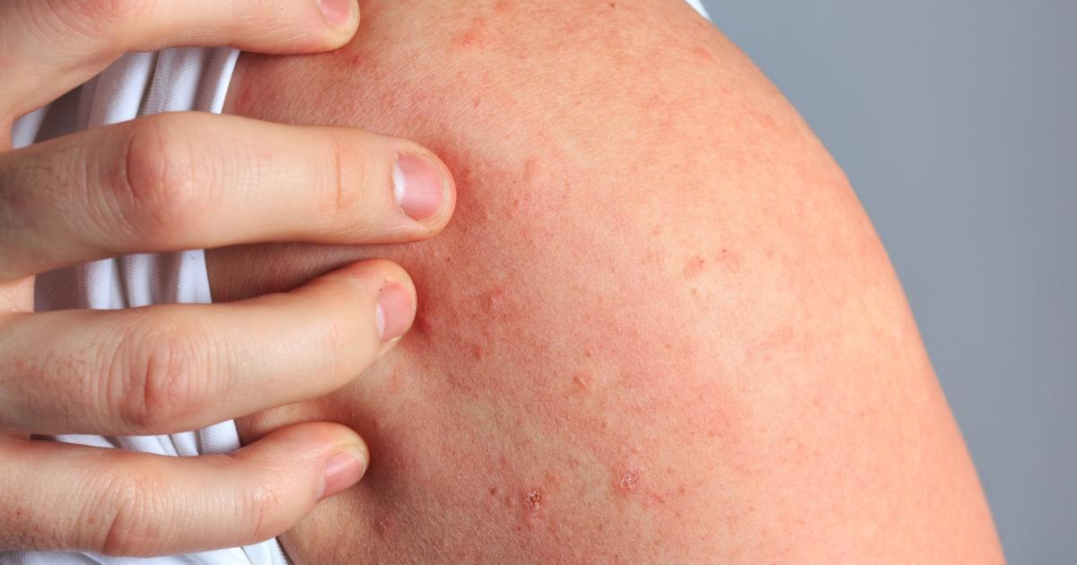 Scabies Rash On Face