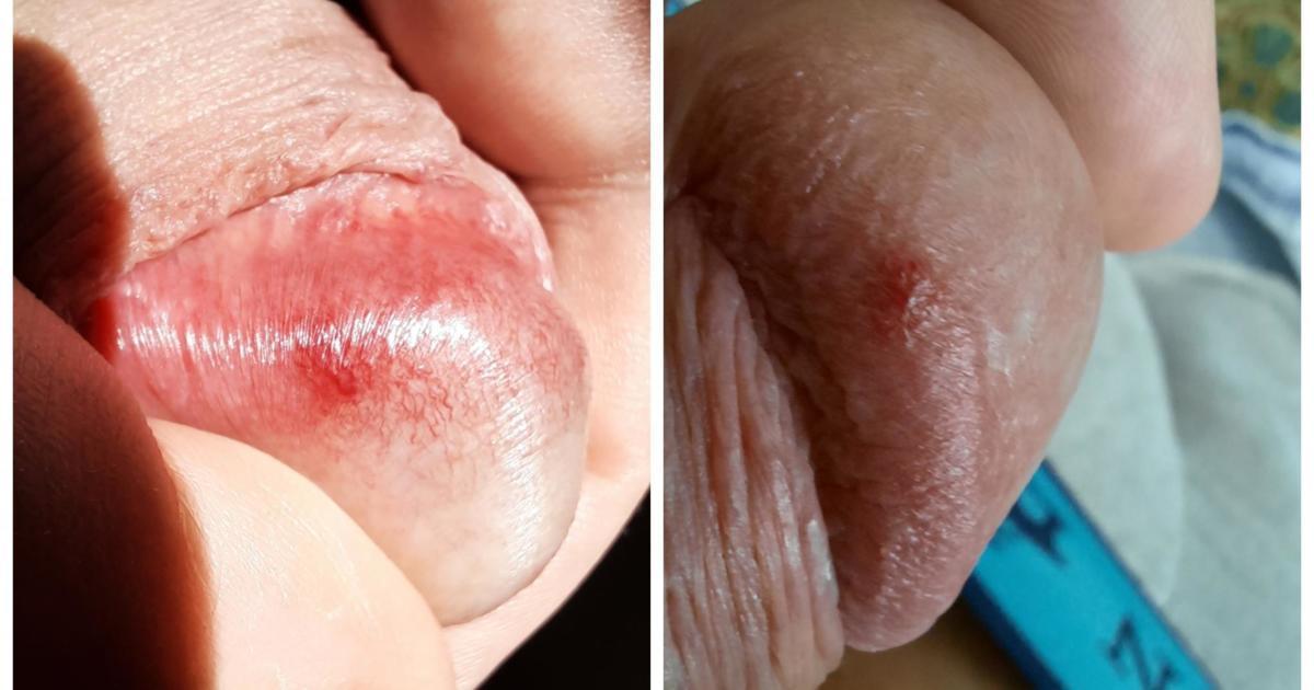 Red spot on under side penis glands?