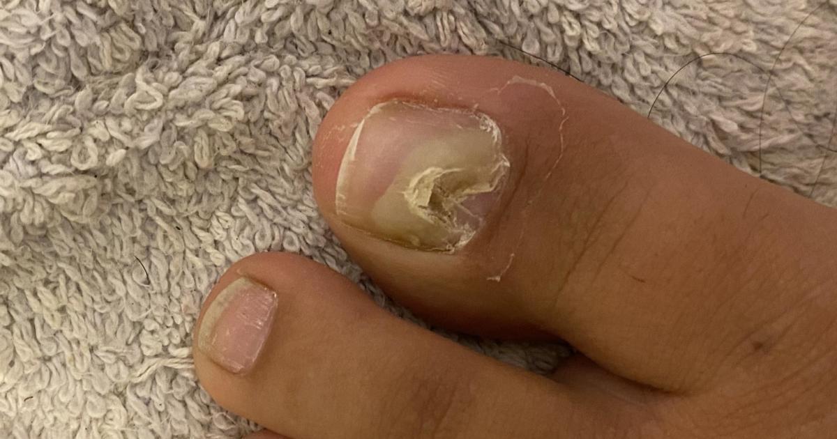 Fungal nail problems - myDr.com.au