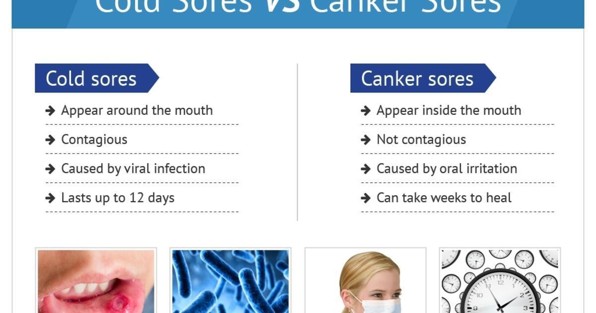 Cold Sores Vs Canker Sores Infographic