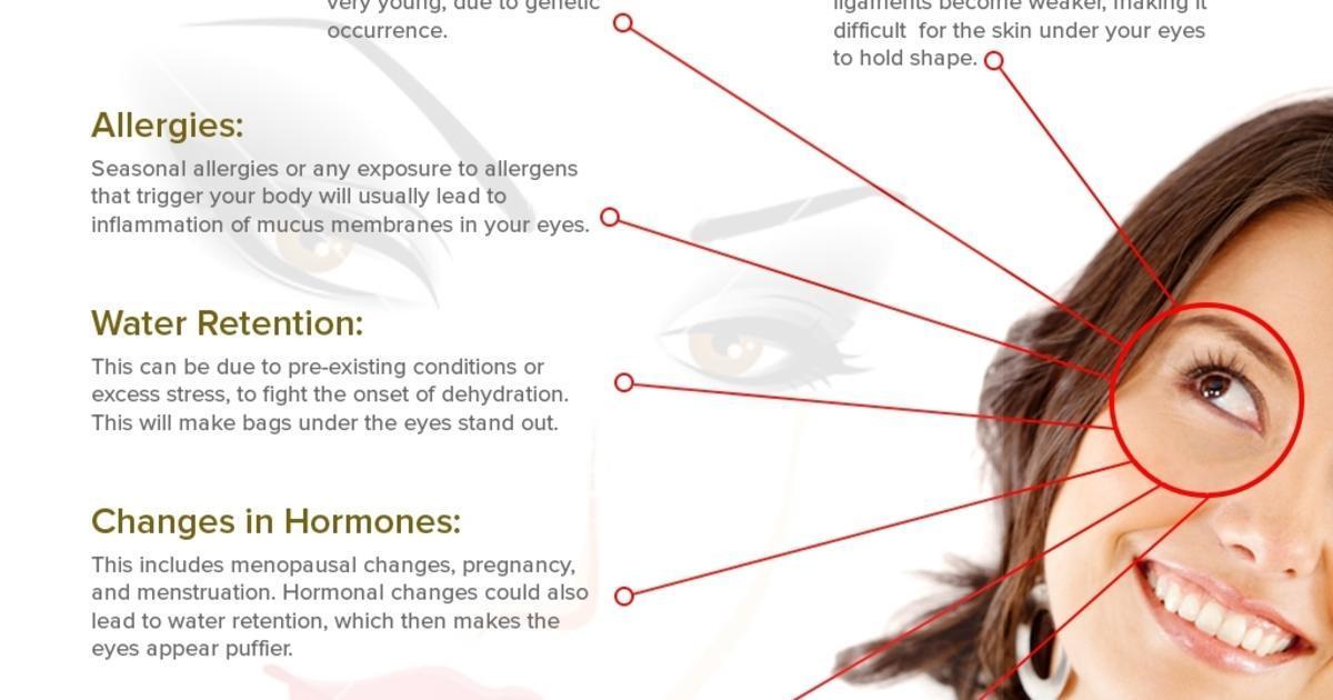 what causes bags under eyes