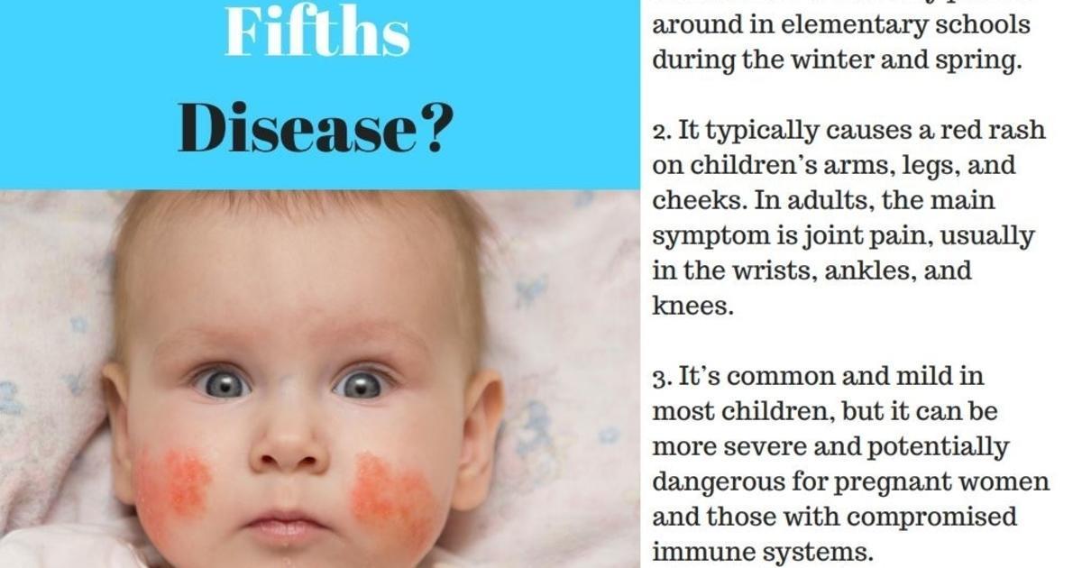 What is Fifths Disease: Causes and Treatment [Infographic]