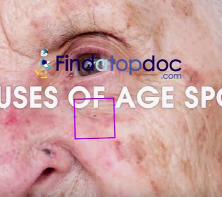 What Are the Causes of Age Spots?
