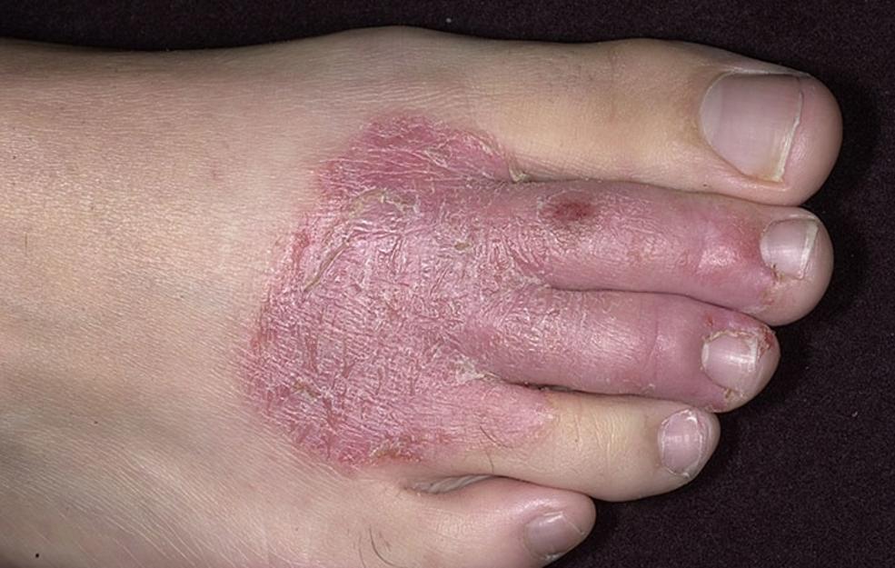 What Are The Causes And Symptoms Of Eczema 