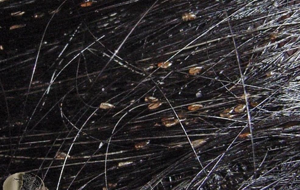 6 natural remedies to get rid of HEAD LICE EGGS FindaTopDoc