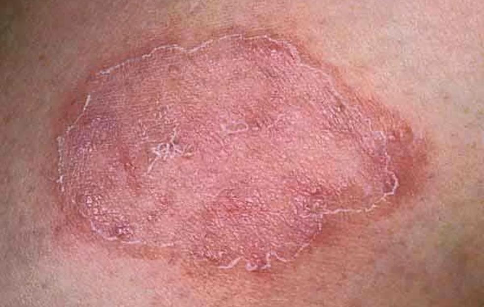 British Wrestling - Ringworm Awareness Here is some basic information on  the occurrence of ringworm & other fungal infections. Clearly this is a  concern amongst our members and at the English Senior