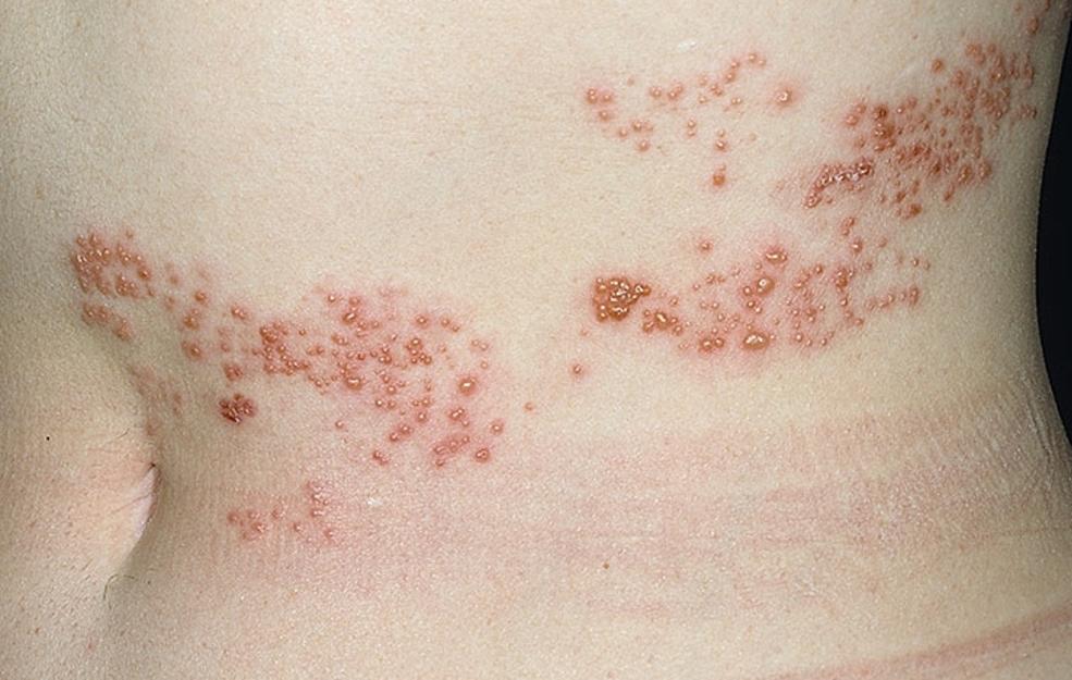 Shingles Rash Pictures What Does Shingles Look Like