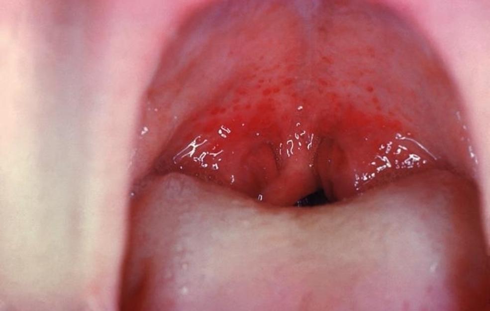 Throat Pics
