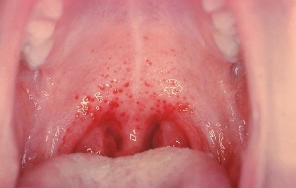 streptococcus throat
