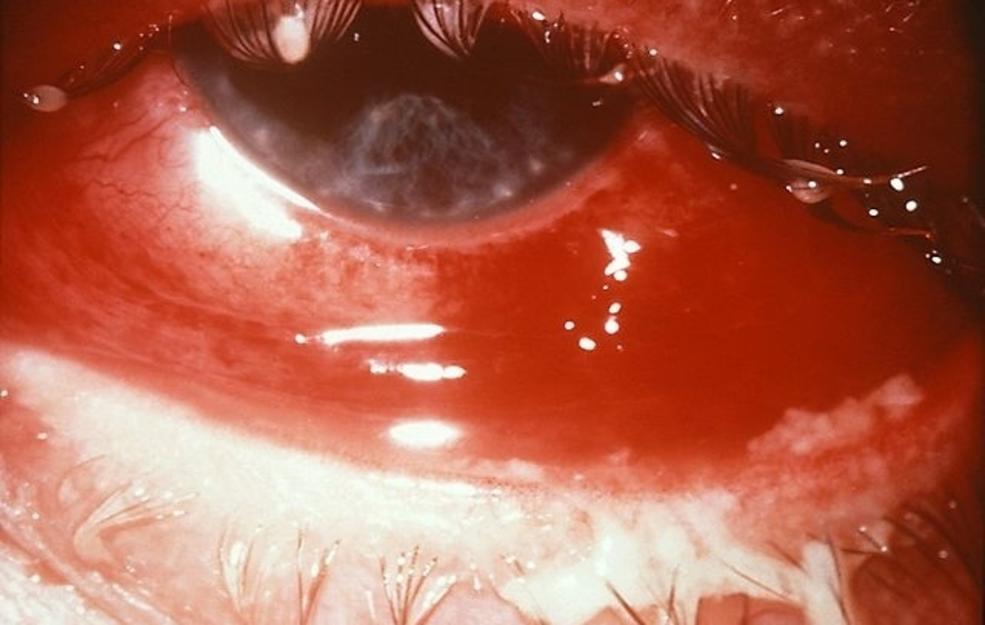 Signs and Symptoms of Pink Eye (Conjunctivitis)