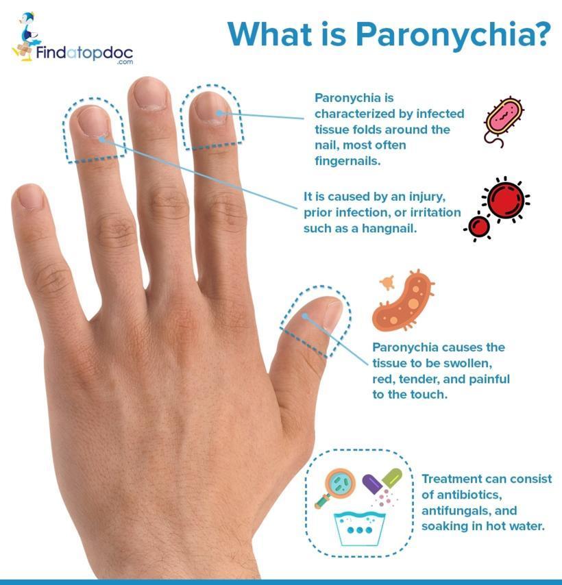 Pointing the Finger - Paronychia in the Emergency Department • St Emlyn's