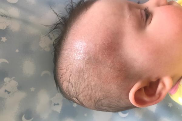 7 month old cradle cap