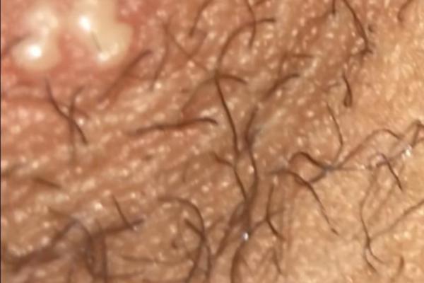 Can Hair Grow Out Of Herpes Bumps? 