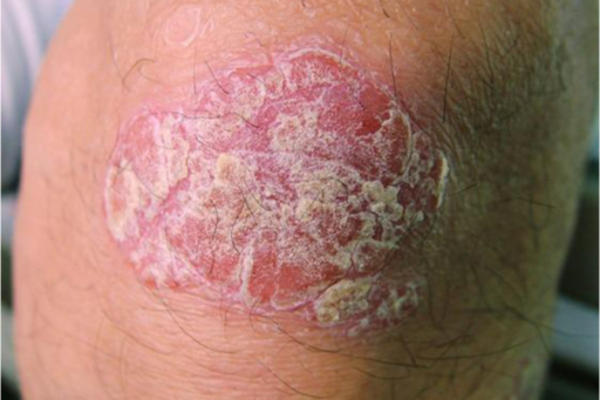 Psoriasis