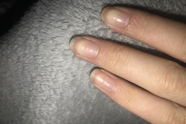 Should I be concerned if I have dents on all my fingernails?