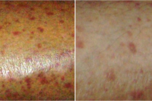 Small Itchy Bumps On Thighs Is It Serious