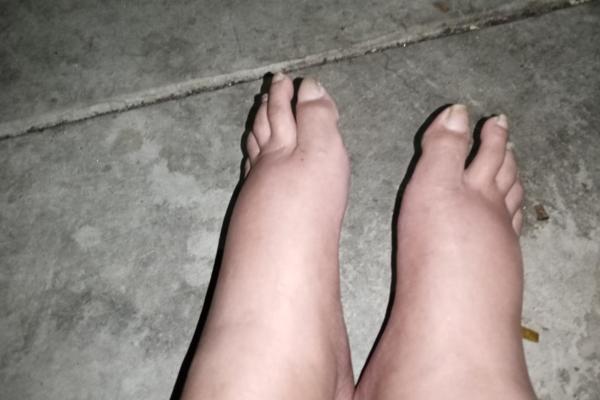 What causes Swollen feet?