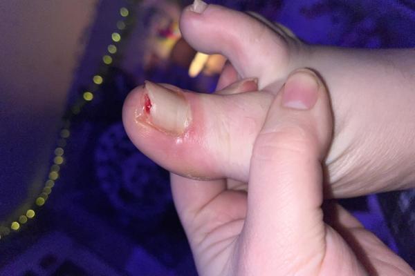 Nails falling off in a 3-year-old | MDedge Family Medicine