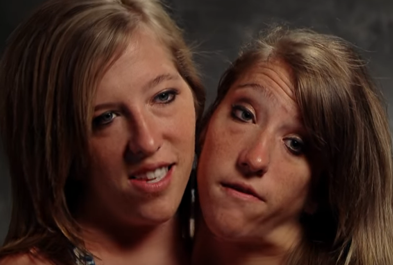 But, conjoined twins like Abby and Brittany can lead happy, healthy ...