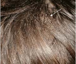 6 natural remedies to get rid of HEAD LICE EGGS - FindaTopDoc