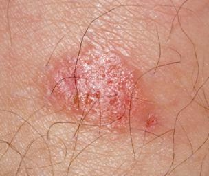 jock itch treatment near me jock itch treatment near me