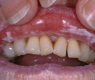 Oral Thrush Pictures: What does Oral Thrush look like?