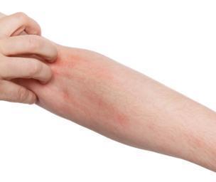 How to Prevent Scabies From Spreading