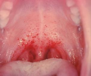 Strep Pictures: What Strep look like?