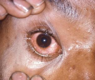 gonorrhea symptoms female mouth gonorrhea symptoms female mouth