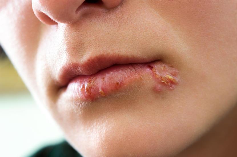 How To Prevent Cold Sores From Spreading 