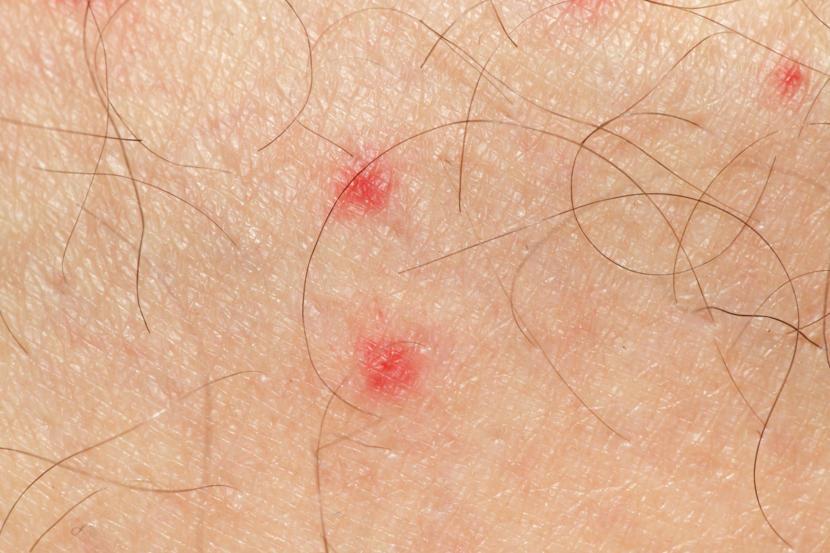 Pinpoint Red Dots On Skin Causes Tdfreeloads