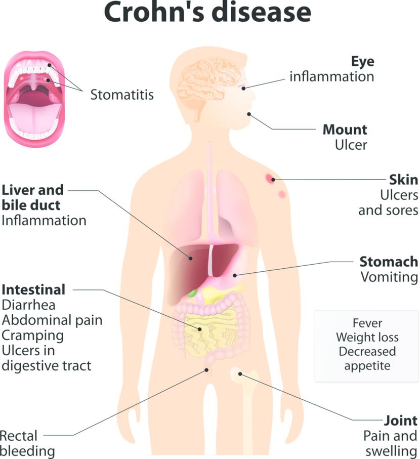 Crohn`S Disease Symptoms Weight Loss
