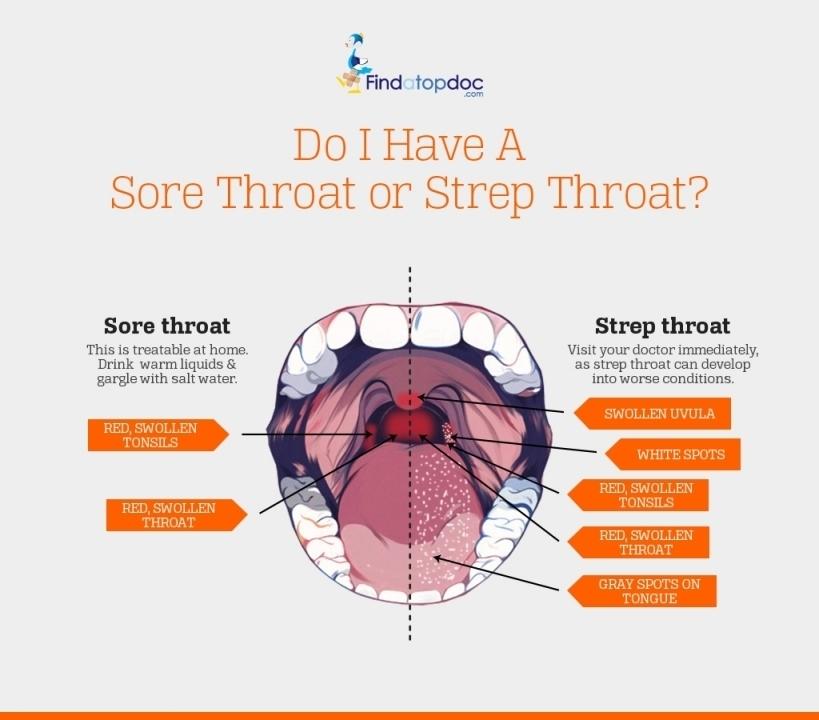 infection Strep adults in throat sypmptoms