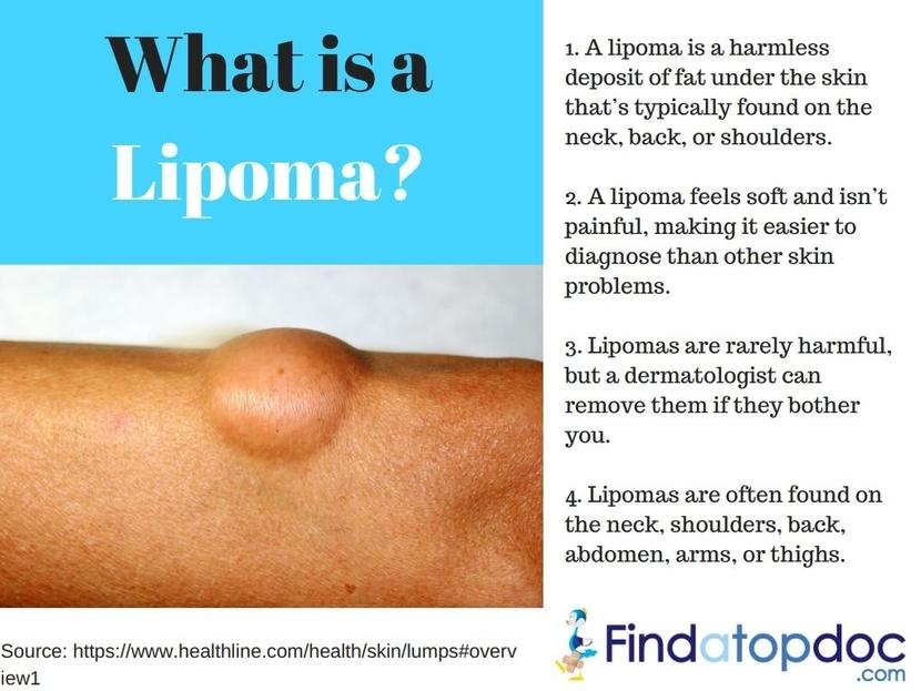 case study of lipoma patient