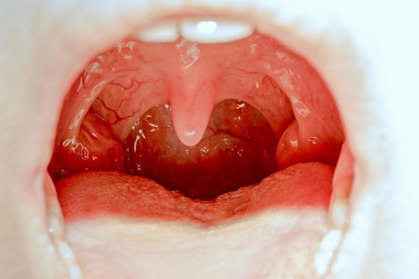 What Does Throat Cancer Look Like Nhs : Tonsillectomy | Flickr - Photo Sharing! : It showed up simply as a swollen lymph node on my neck like symptoms, the signs of cancer vary based on the type and location of the tumor.